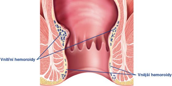 leva od hemeroid